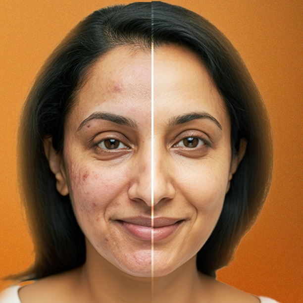 Acne & Scar Treatment: Clear Skin is Possible
